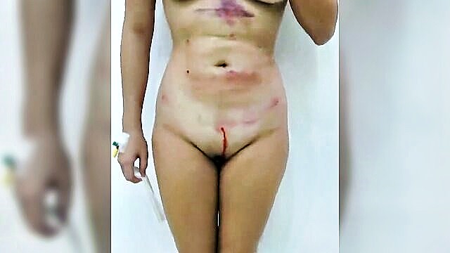 video, nudity, case - case 43 video 5 abdominal liposuction on a national swimmer nudity sexually and explicit video on youtube case 43 video 5 abdominal liposuction on a national swimmer watch free nsfw nude ex