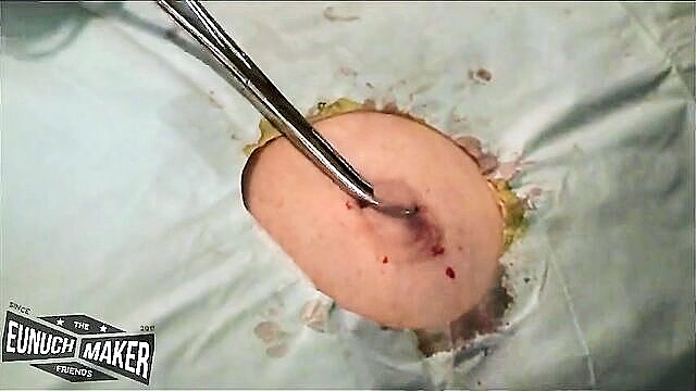 pain, bizarre, nipples - nipple surgery xxx